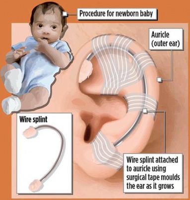 درمان بدشکلی گوش نوزادان با آتل سیمی