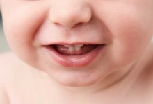 دندان نیش نوزاد
