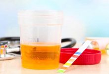 سفیدی در ادرار