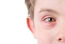 جشم صورتی کودک