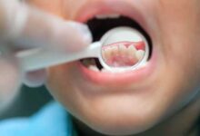 عفونت لثه کودک