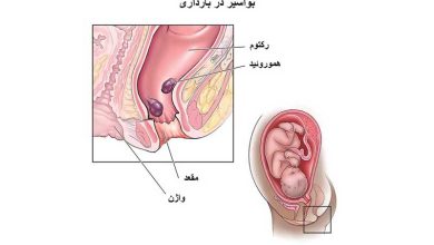 بواسیر در بارداری