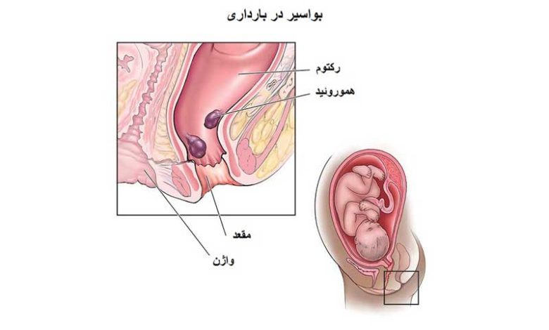 بواسیر در بارداری