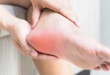 درمان خار پاشنه با پودر موبر+ با شیشه نوشابه